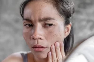 Strategi Mengatasi Masalah Kulit Kering dan Kusam